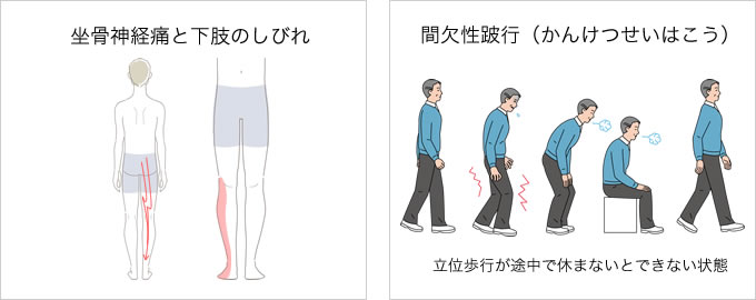 坐骨神経痛と下肢のしびれ 間欠性跛行（かんけつせいはこう）立位歩行が途中で休まないとできない状態